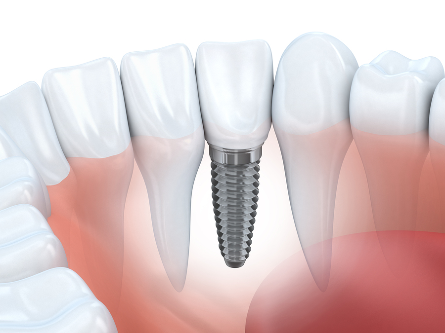 Dental Implants Parsippany NJ
